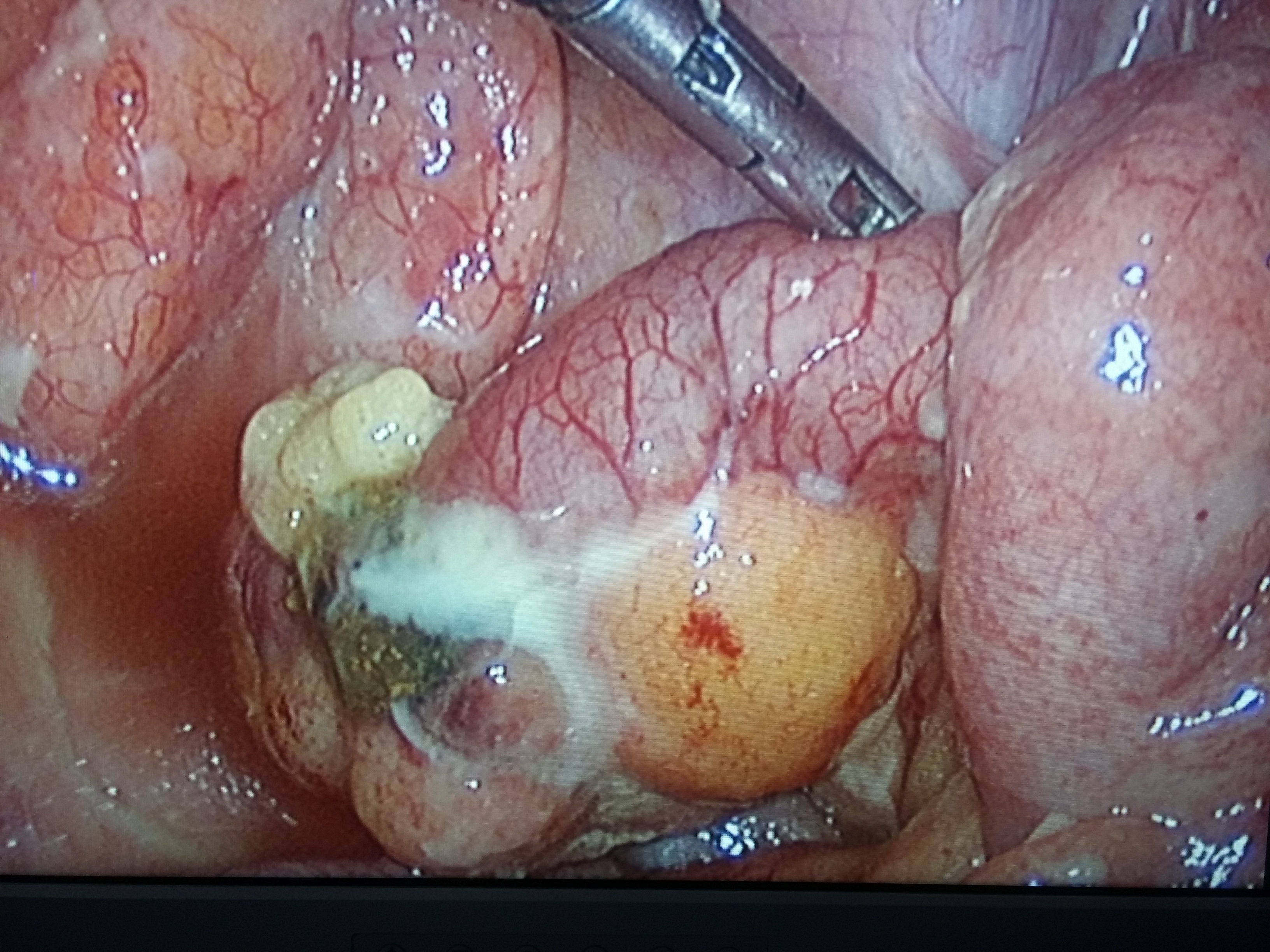 Admin/uploads/11_06_201810_23Perforated Appendix.jpg